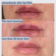 AfterMED Lips – Advanced Lip Recovery for Post-Treatment Care